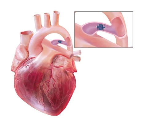 بیماری مجرای شریانی باز در کودک تازه متولد شده و یا بزرگسال (PDA)