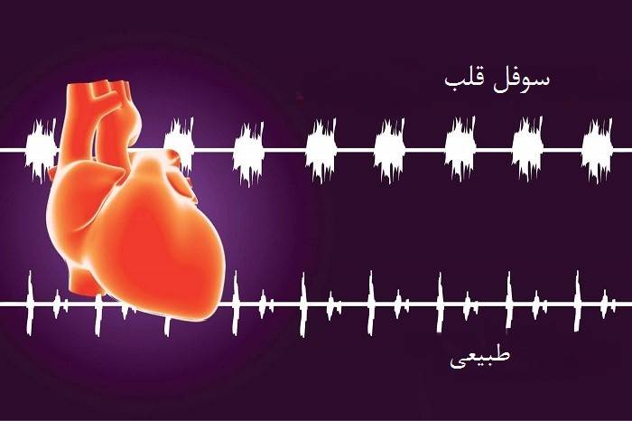 سوفل قلب چیست؟