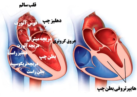 هایپرتروفی قلب